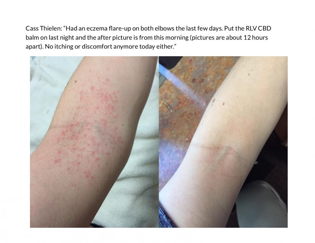 Eczema results with RLV Hemp Balm